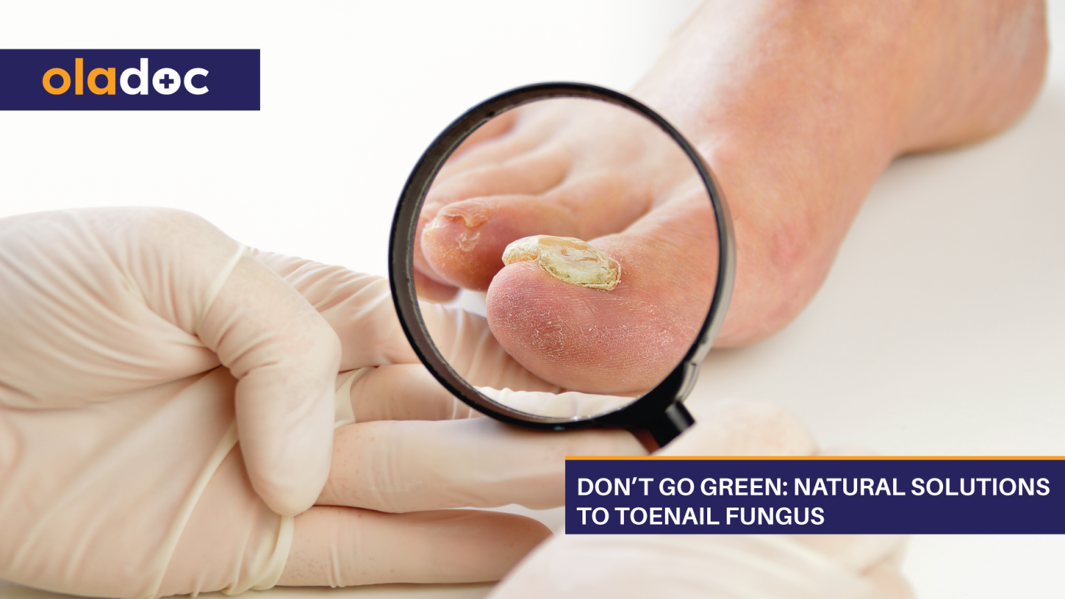 Don’t Go Green: Natural Solutions To Toenail Fungus | Beauty and Skin ...