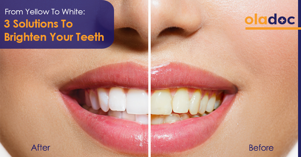 Get The Perfect Smile: 3 Ways To Straighten Your Teeth