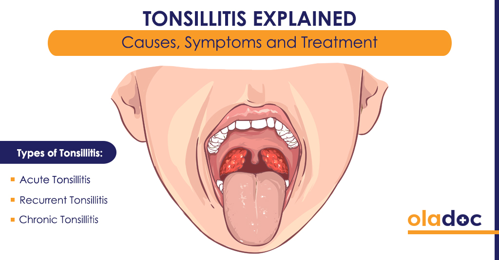 Tonsillitis Explained: Causes, Symptoms, And Treatment