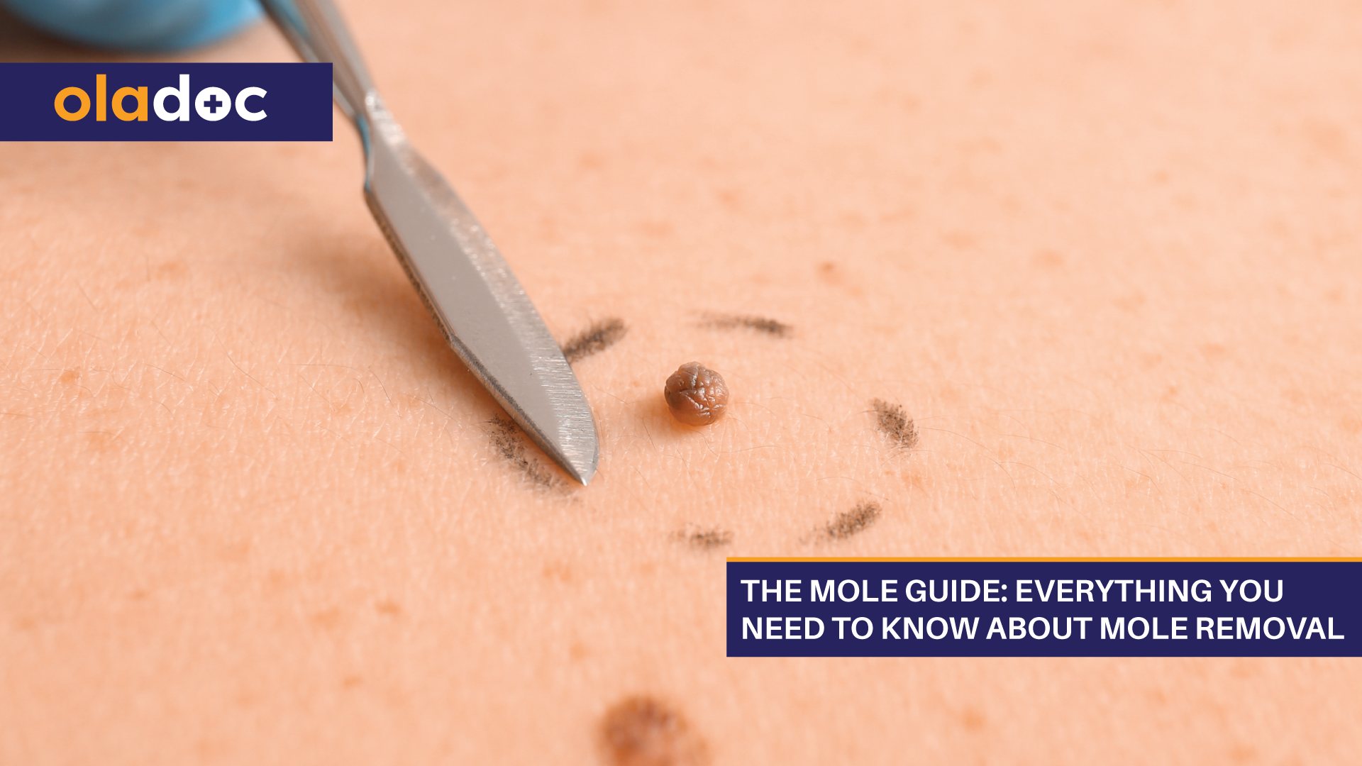 The Mole Guide Everything You Need To Know About Mole Removal Beauty And Skin Care