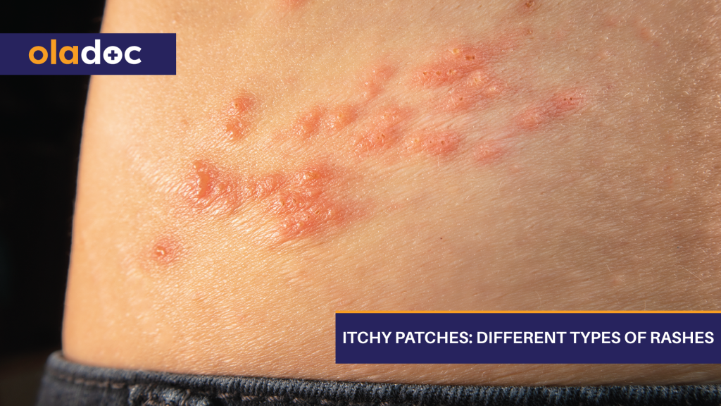 Itchy Patches Different Types Of Rashes Beauty And Skin Care