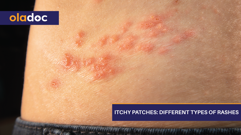 itchy-patches-different-types-of-rashes-beauty-and-skin-care