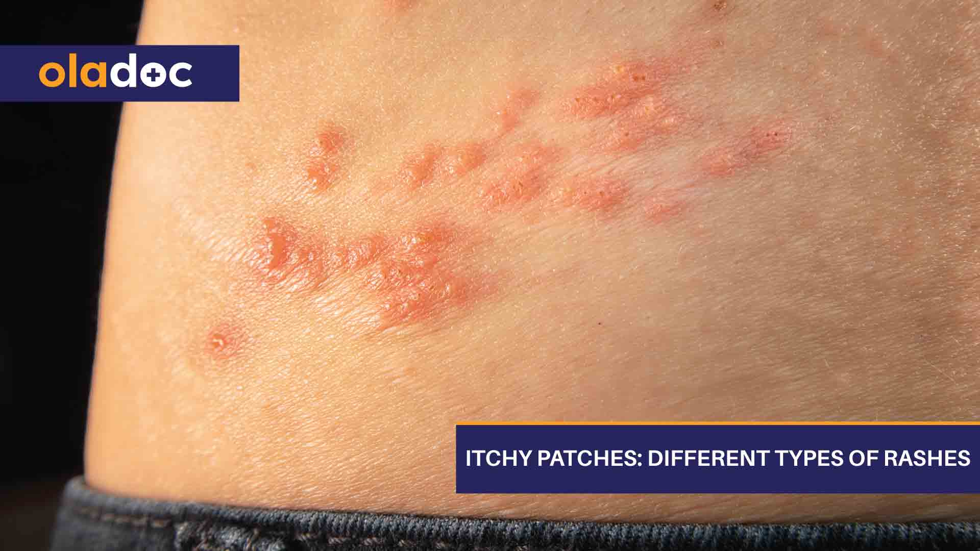 Itchy Patches Different Types Of Rashes Beauty And Skin Care 