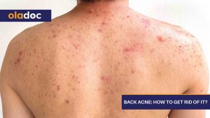 Back-Acne-How-to-Get-Rid-of-It