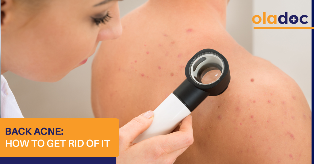 Back Acne: How to Get Rid of It?