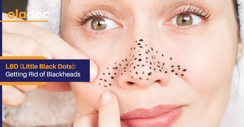 Little Black Dots: Getting Rid of Blackheads