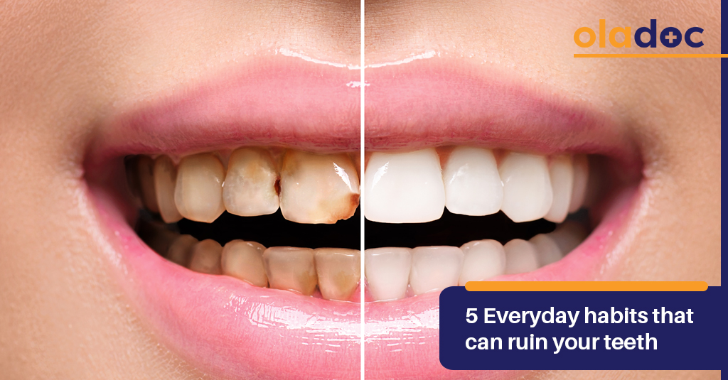 5 Everyday Habits That Can  Ruin Your Teeth