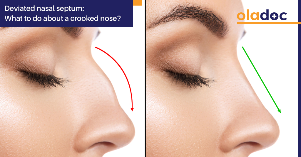 Deviated Nasal Septum: What To Do About A Crooked Nose?