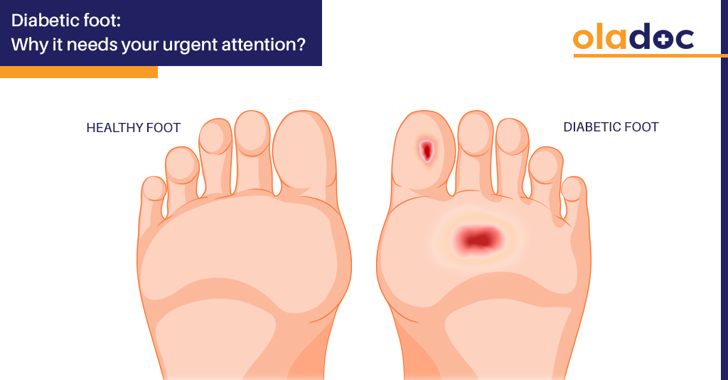 Diabetic Foot: Is Amputation The Only Solution?