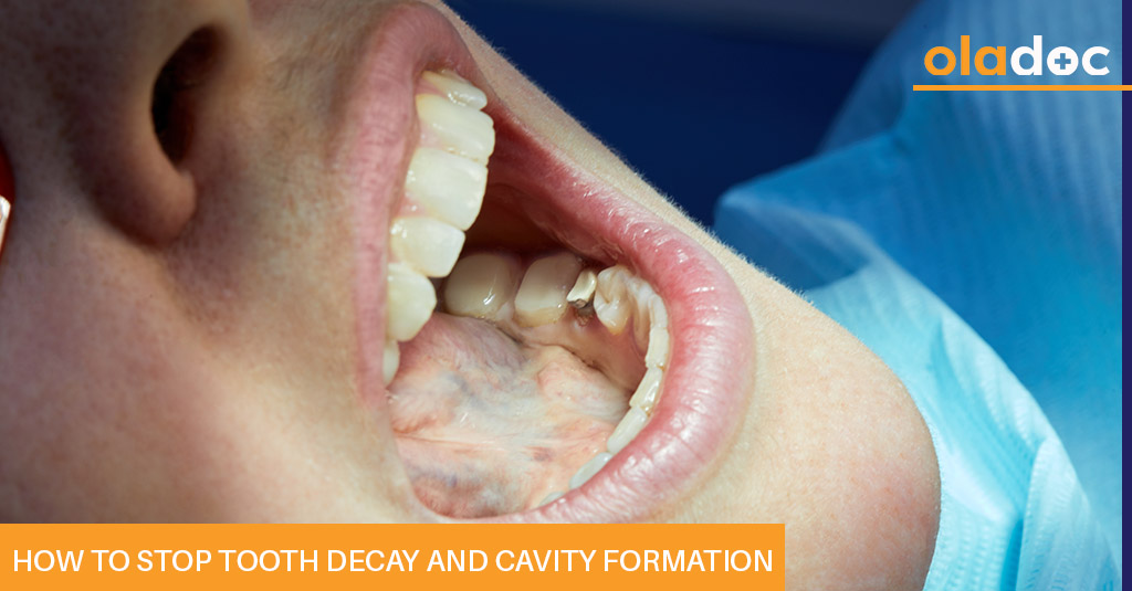 How to Stop Tooth Decay and Cavity Formation