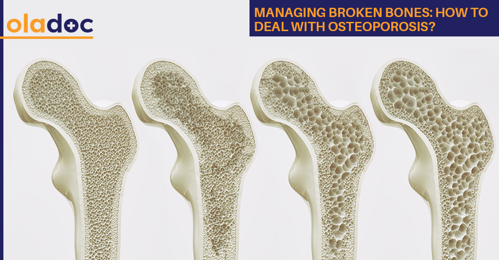 Managing Broken Bones: How to Deal With Osteoporosis?