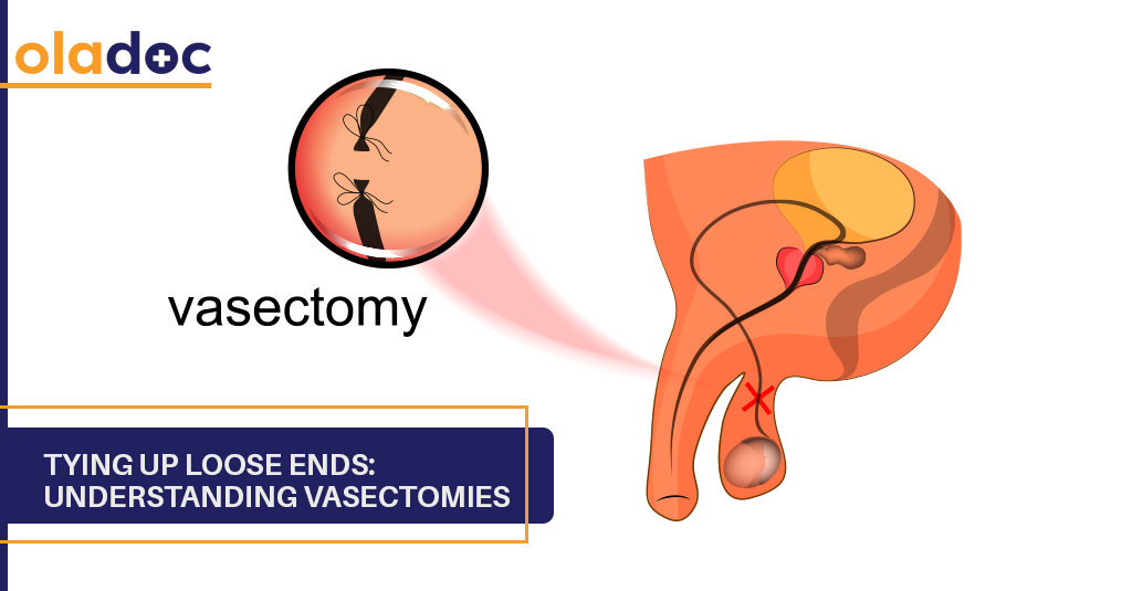 Tying up Loose Ends: Understanding Vasectomies