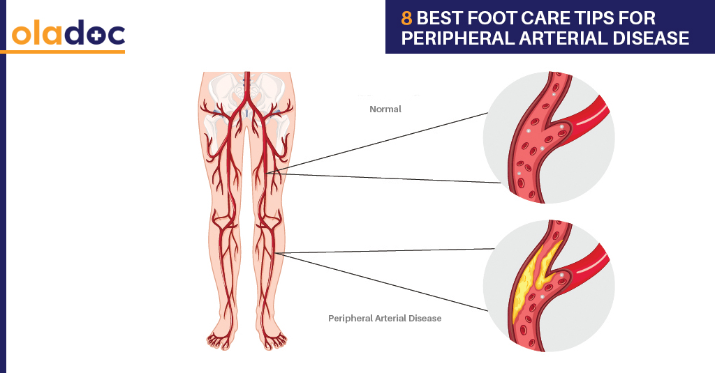 8 Best Foot Care Tips for Peripheral Arterial Disease