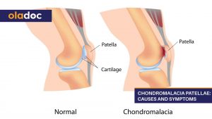 Chondromalacia-Patellae-Causes-and-Symptoms