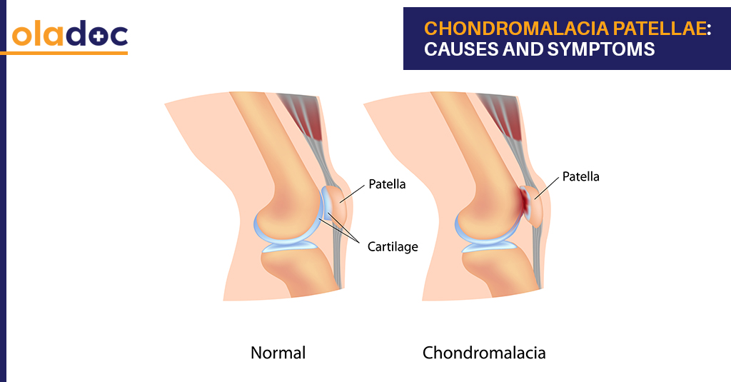 Chondromalacia Patellae: Causes and Symptoms