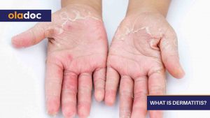 What-Is-Dermatitis