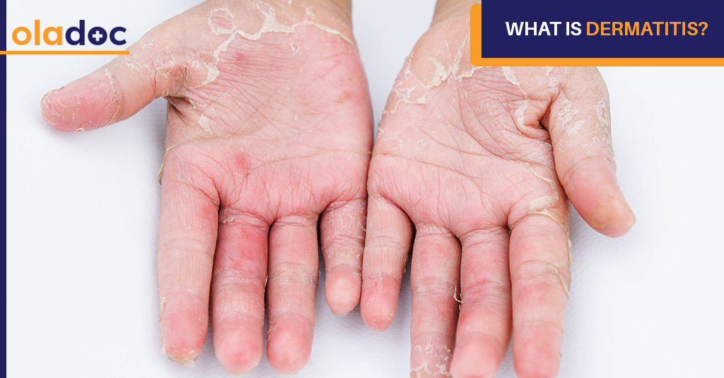 What Is Dermatitis?