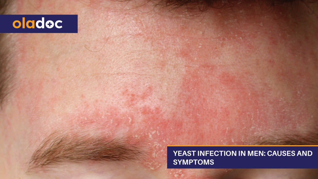 Yeast Infection In Men  1024x576 
