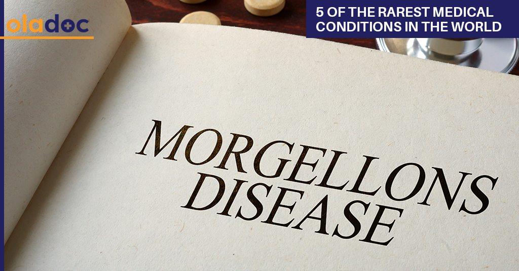 Top 5 Rare Diseases in the World