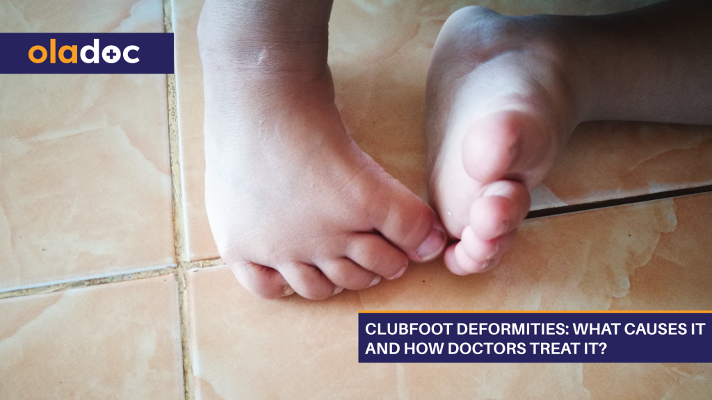 Clubfoot Deformities What Causes It And How Doctors Treat It? Bones