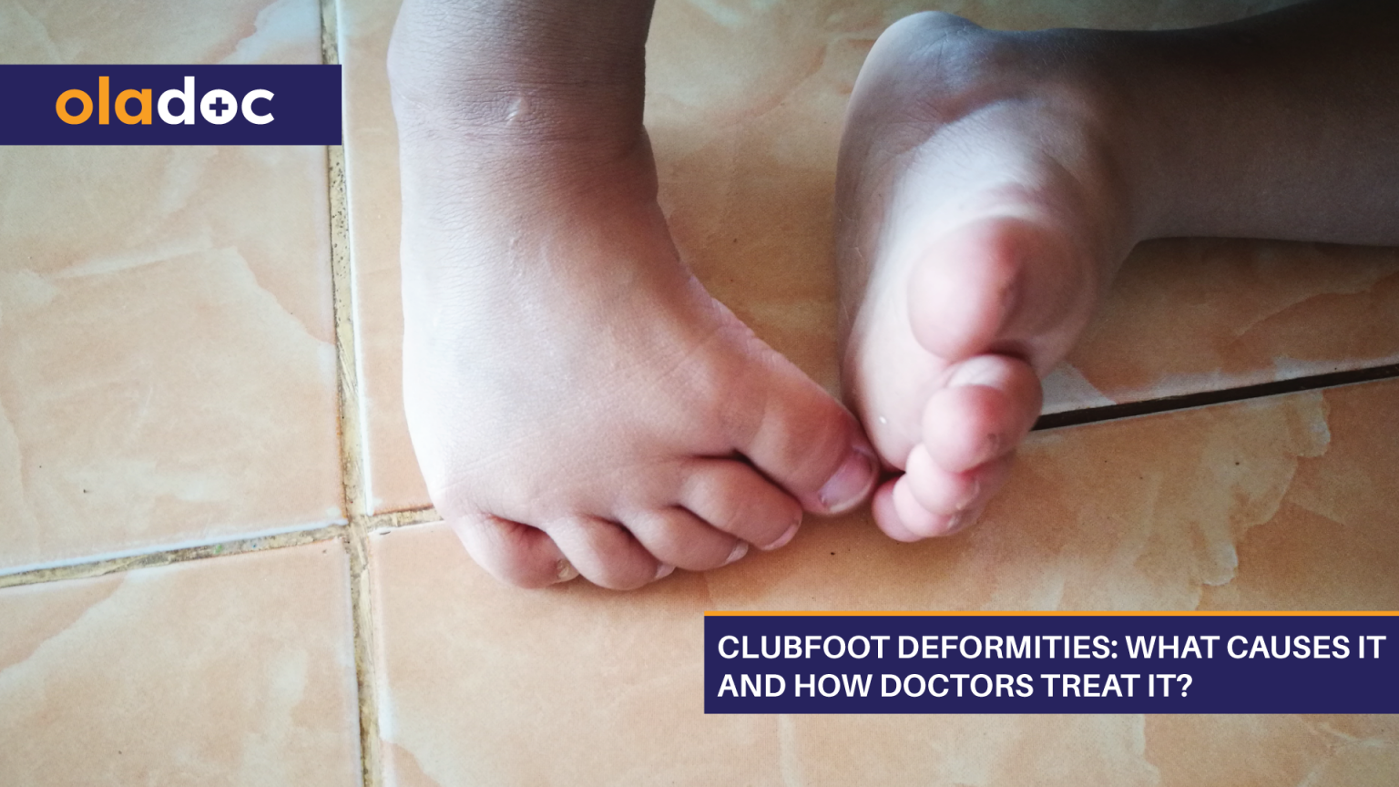 Clubfoot-Deformities-What-Causes-It-And-How-Doctors-Treat-It | Oladoc.com