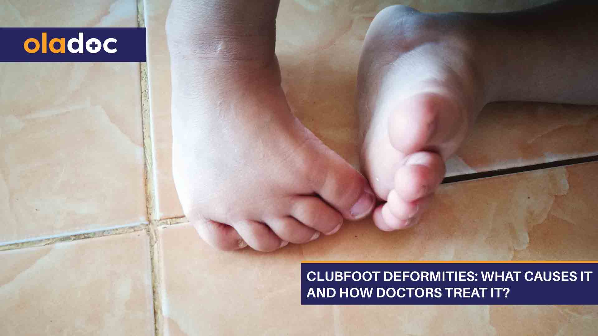 Clubfoot Deformities What Causes It And How Doctors Treat It Bones And Joints Oladoc Com