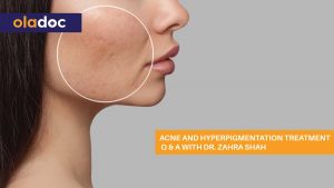 acne-hyperpigmentation-treatment
