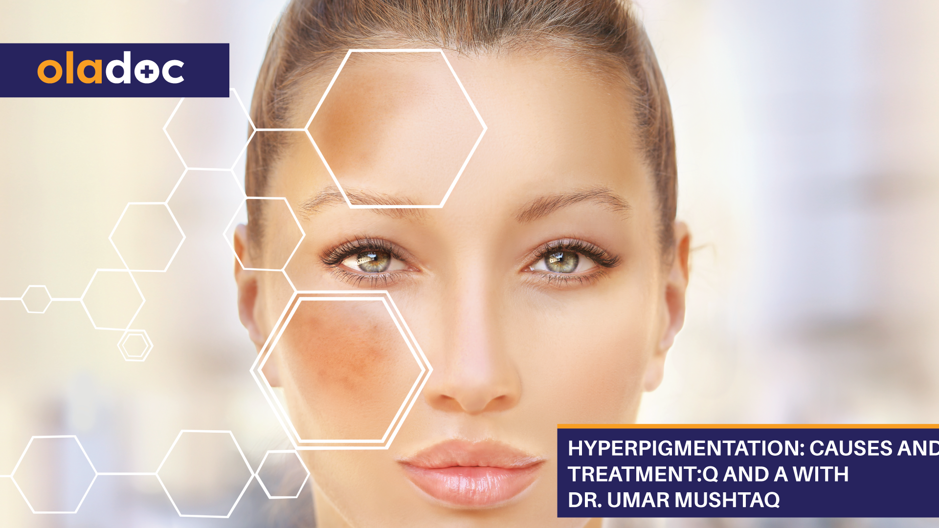 Hyperpigmentation: Causes And Treatment: Q And A With Dr. Umar Mushtaq