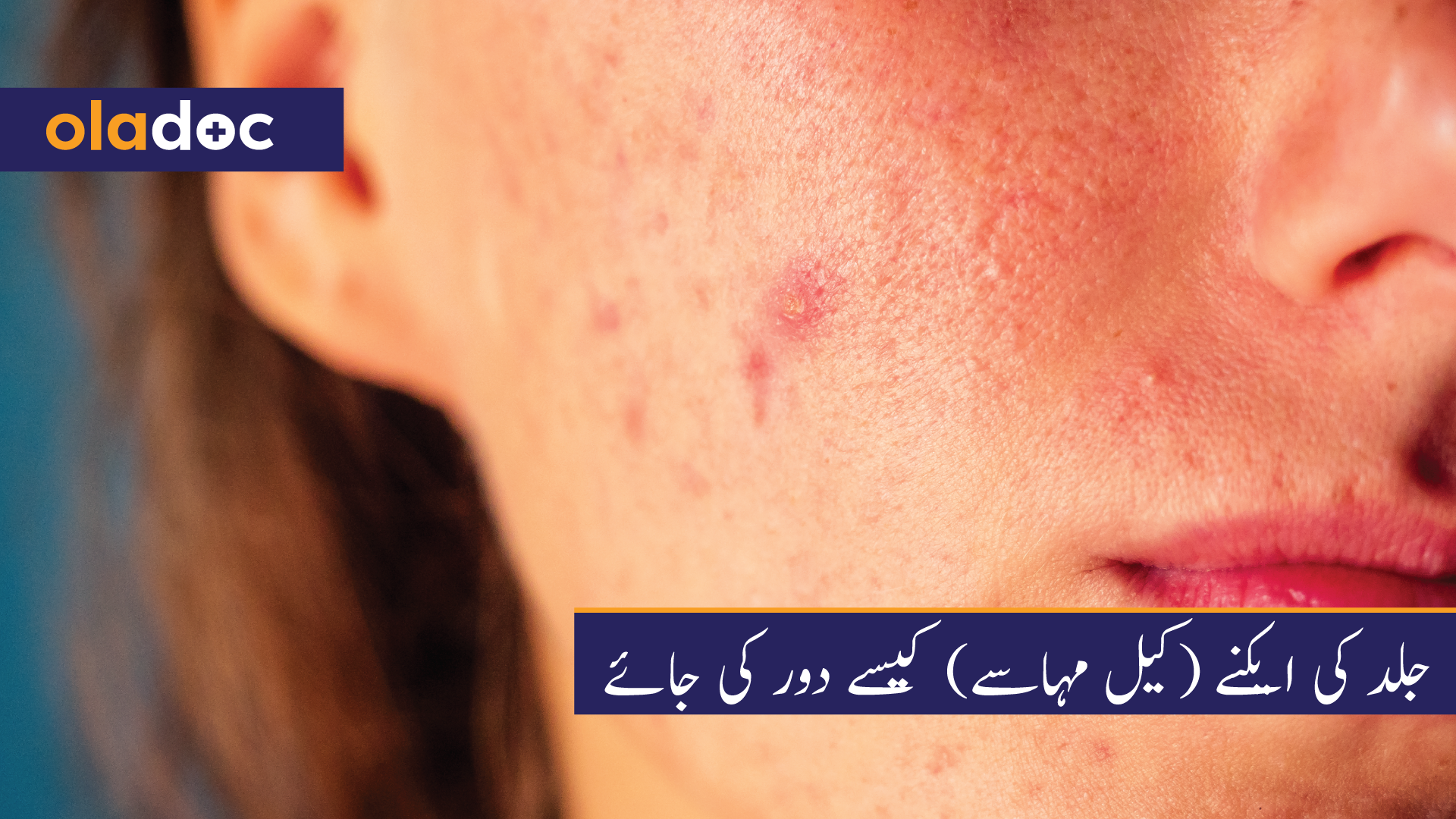 جلد کی ایکنے (کیل مہاسے) کیسے دور کی جائے