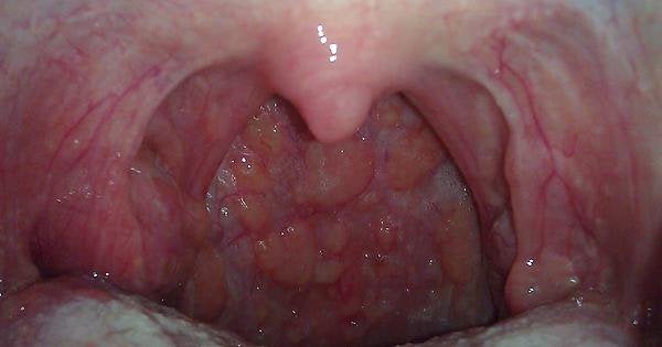 Bumps in back of throat