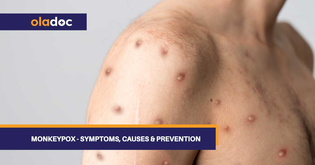 Monkeypox – Symptoms, Causes & Prevention
