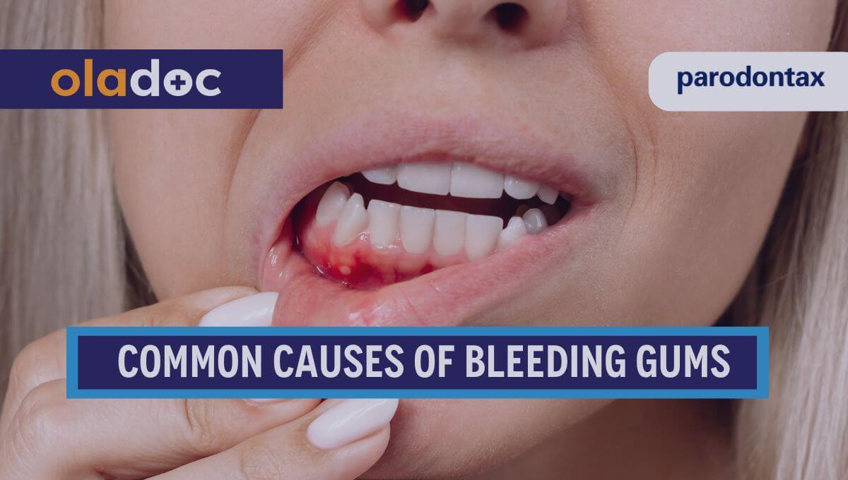 10 Common Reasons Your Gums Might Be Bleeding