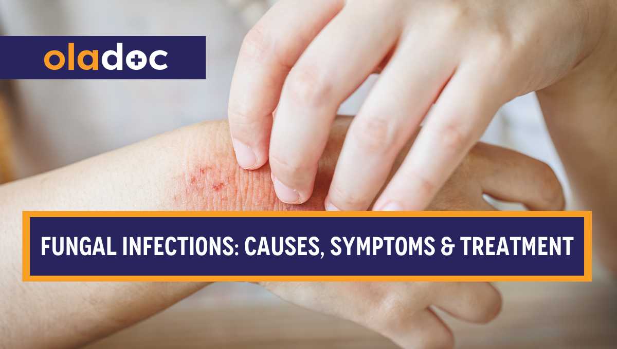 Fungal Infections: Causes, Symptoms & Treatment