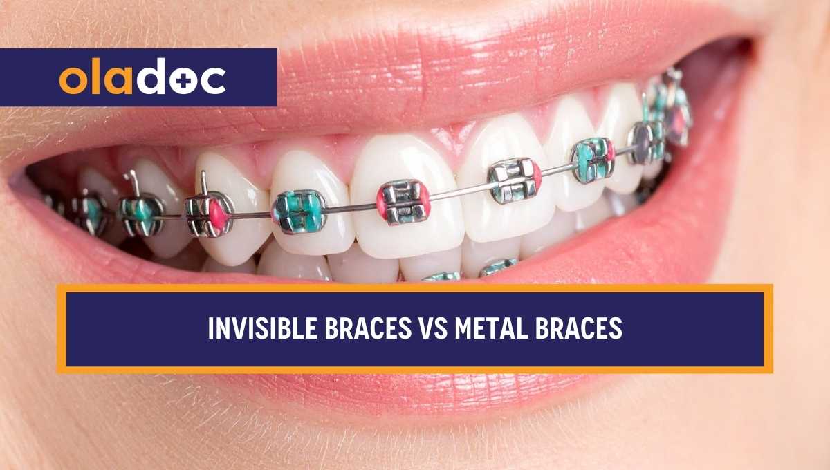 Invisible Braces vs Metal Braces: Which Should You Choose? thumbnail
